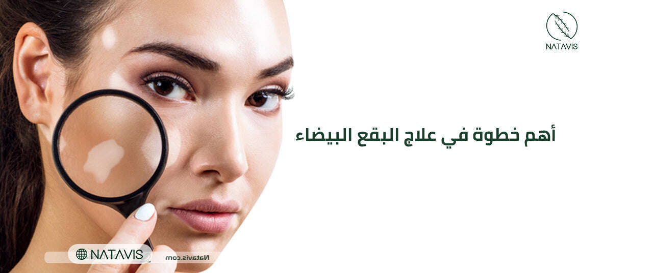 Treating White Spots on The Face for A Clear, Uniform Skin Tone Natavis