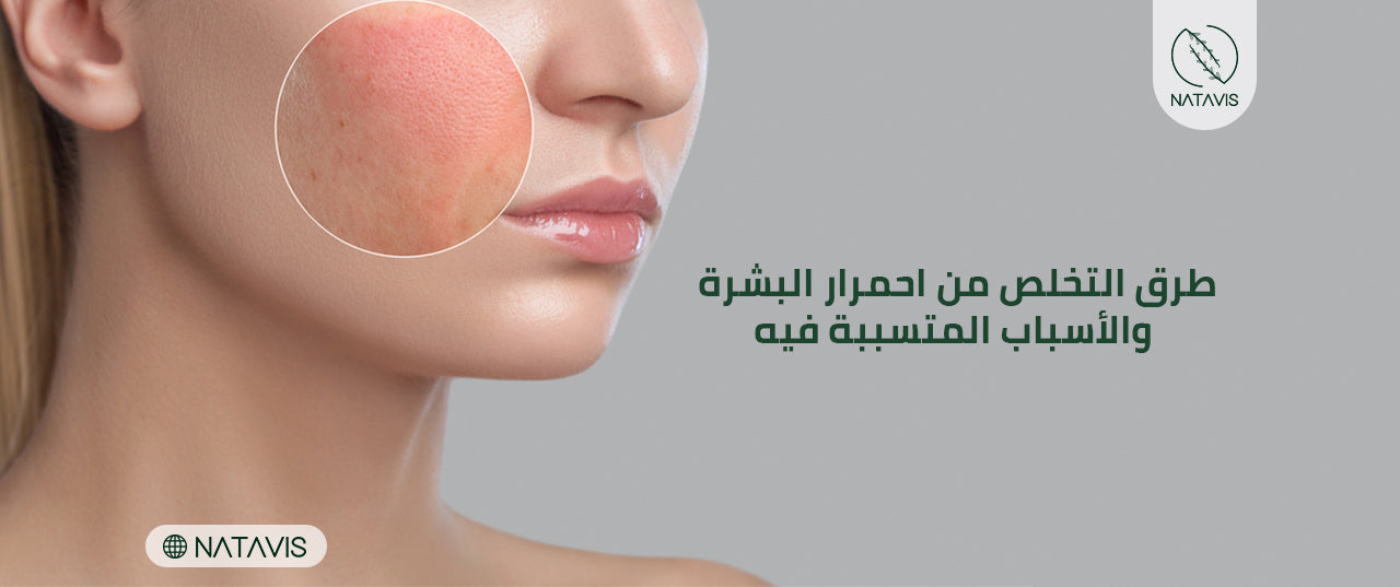 Ways to Get Rid of Skin Redness