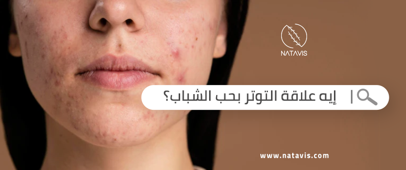 What Is The Relationship Between Stress And Acne? Natavis